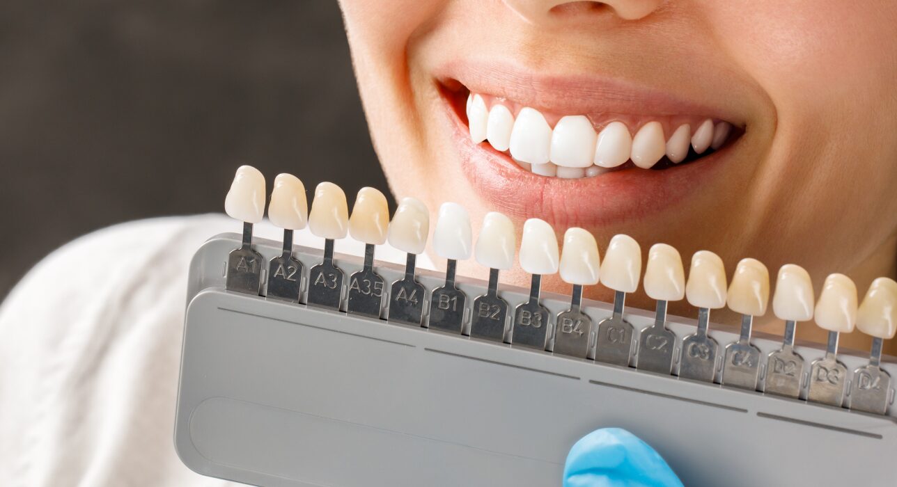 Dental Venners