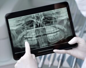 Dental X-Ray